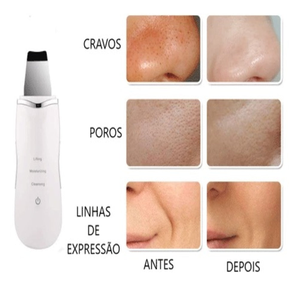 Peeling Ultrassônico Facial – Limpeza Profunda e Lifting