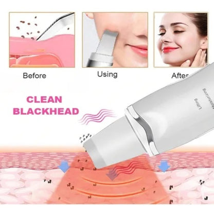 Peeling Ultrassônico Facial – Limpeza Profunda e Lifting